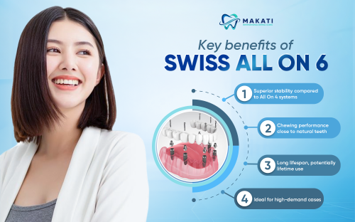 Key benefits of choosing Swiss All-on-6 for premium dental restoration